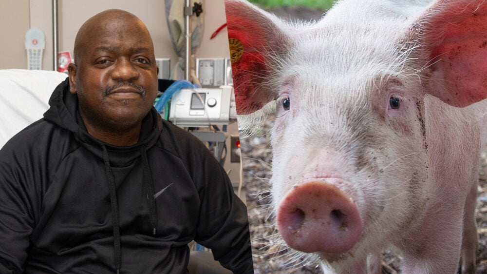 В США умер первый в мире пациент с пересаженной почкой генно-модифицированной свиньи